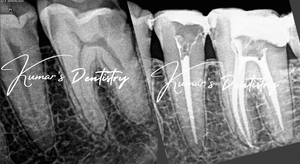 Microscopic Root Canal Treatment