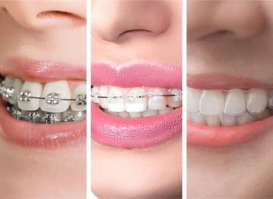 Metal Braces