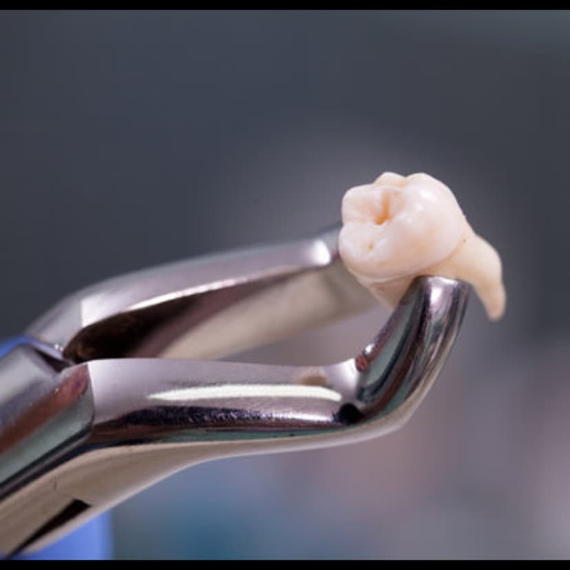 Tooth Extraction