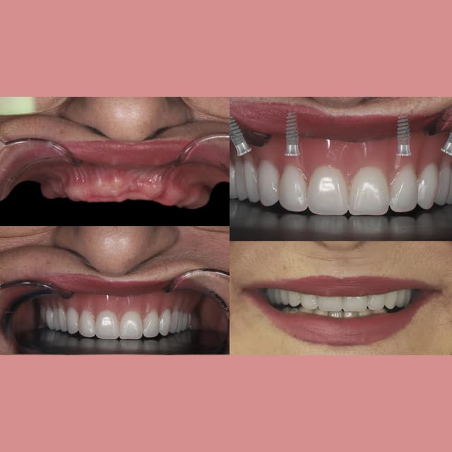 Dental implants procedure