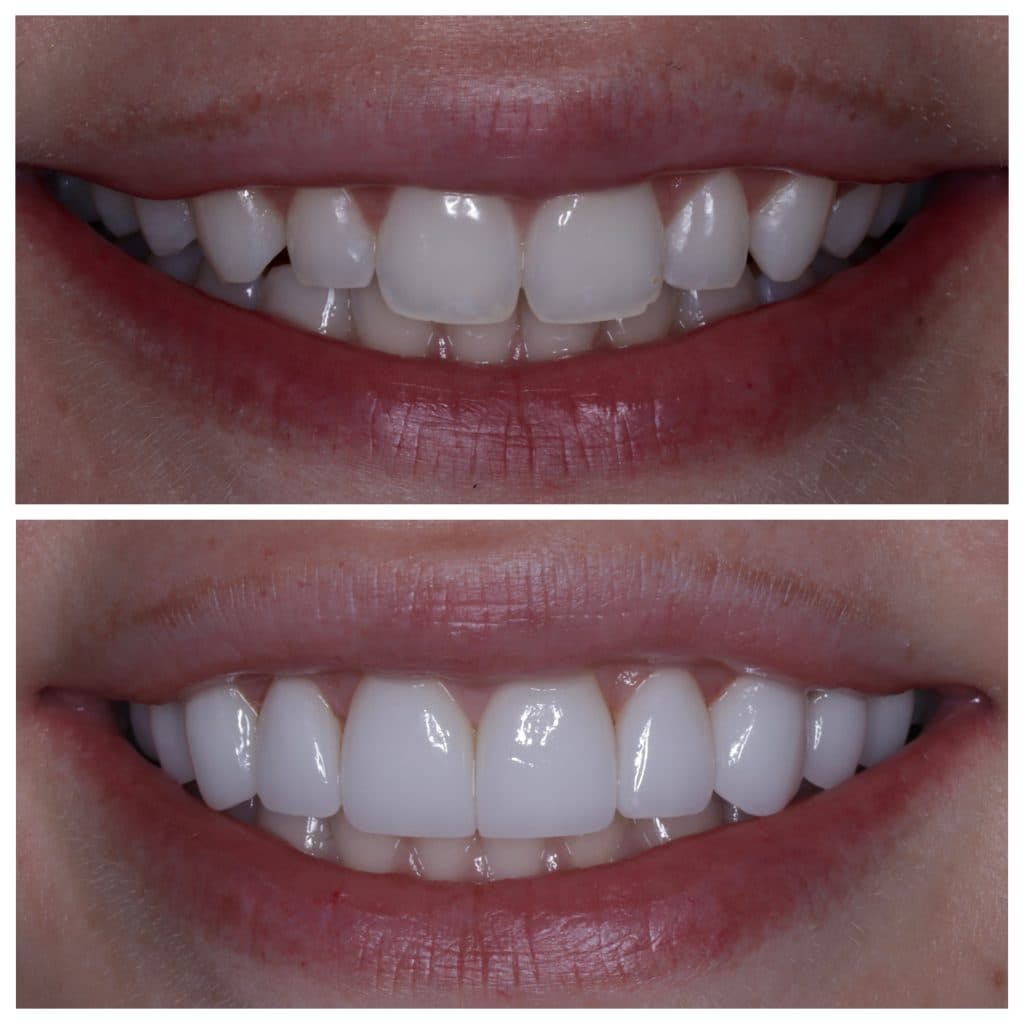 Smile Designing