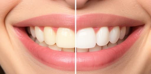 Teeth Whitening